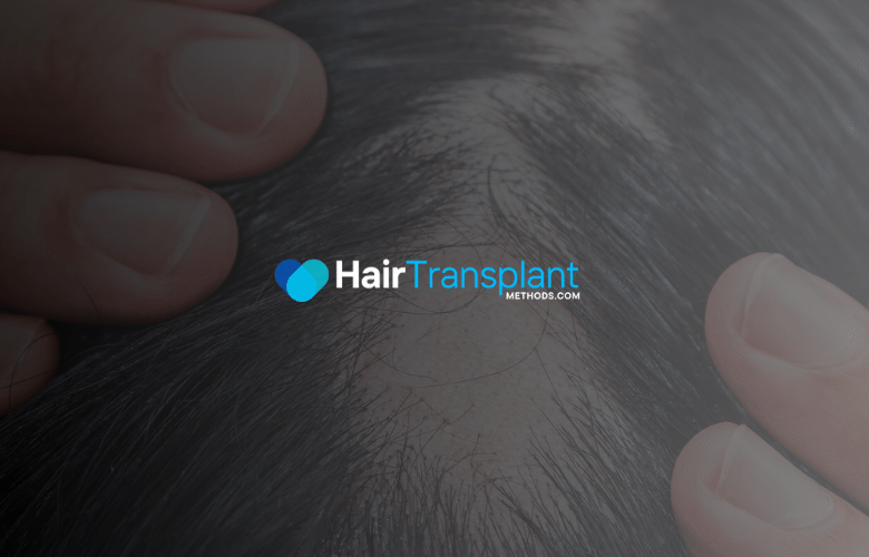 Causes of Trauma-Induced Hair Loss