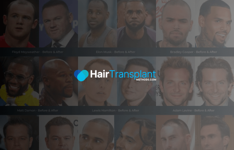 Celebrity Hair Transplants & Hair loss is a common problem that affects millions of people around the world, including celebrities. Over the years, many celebrities have undergone hair transplant surgery to restore their hairline or improve the density of their hair. In this article, we will take a look at some famous celebrities who have had hair transplant surgery and how it has changed their appearance.