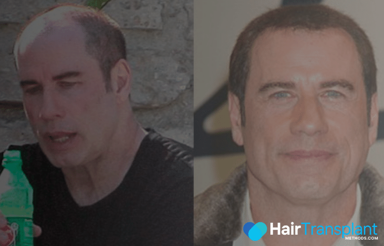 John Travolta Hair Transplant